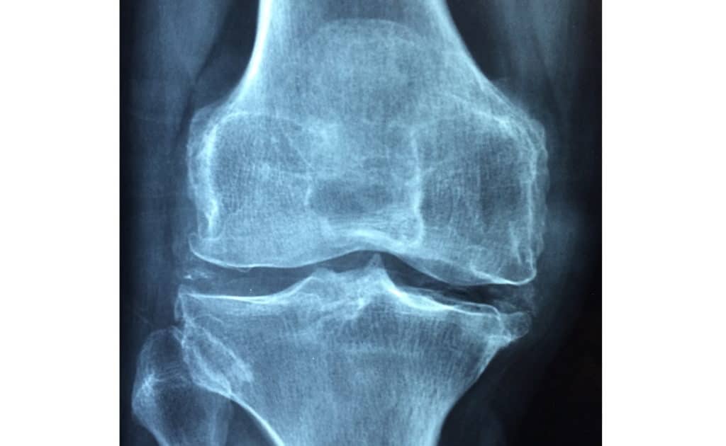 arthrose et sport