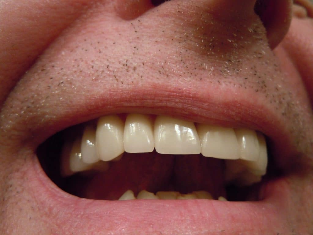 hygiene dentaire sport